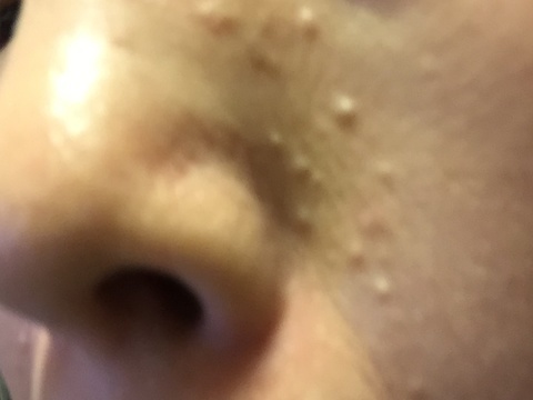 稗粒腫取り方 艶つや習慣で目の下に白いぶつぶつ 稗粒腫 はいりゅうしゅを綺麗にしたい